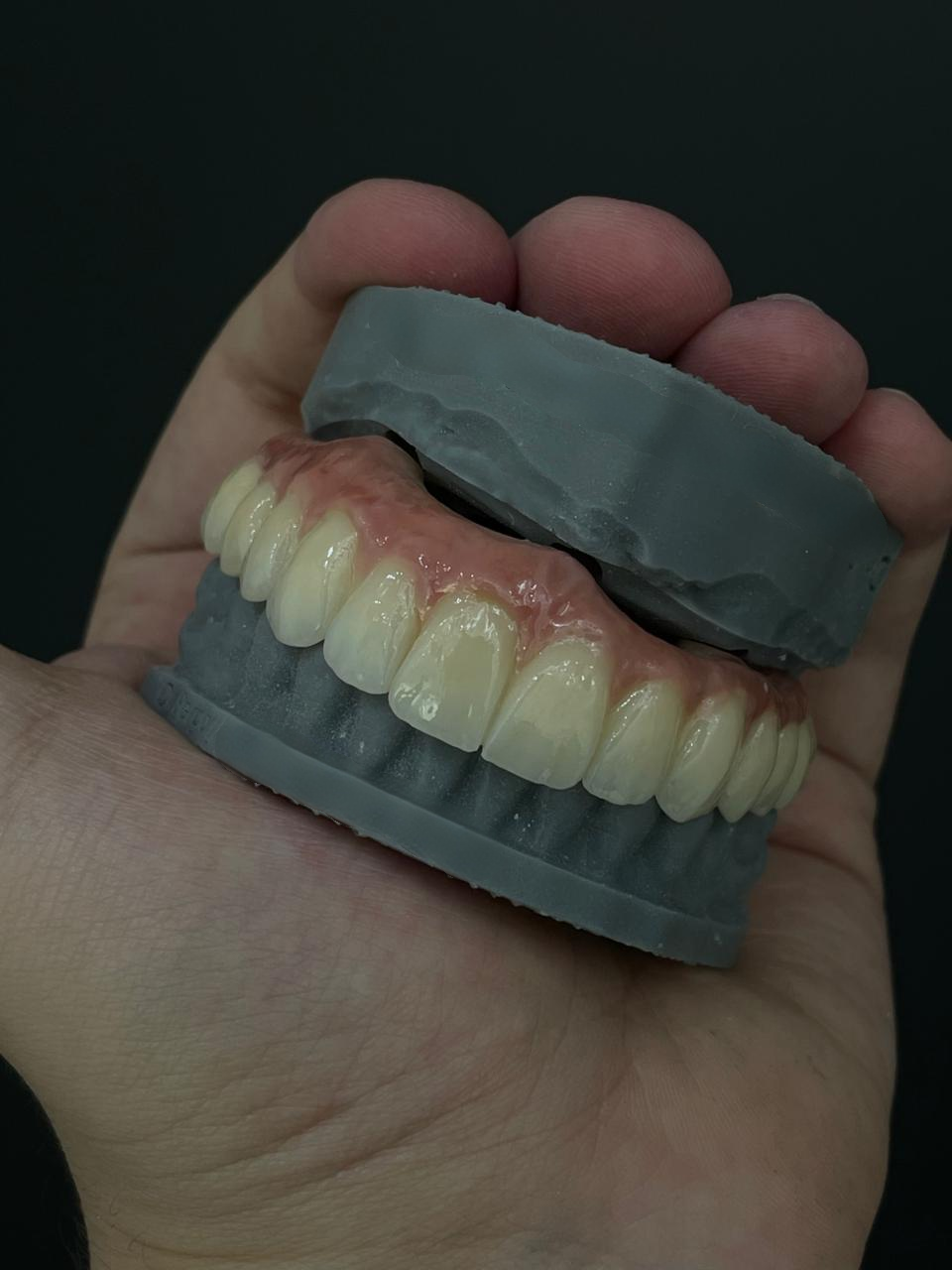 Aktueller Firmenfall über Natürliche Ästhetik mit Zirkonoxid erreichen: Ein erfolgreicher Fall einer Vollkieferrestauration aus Brasilien