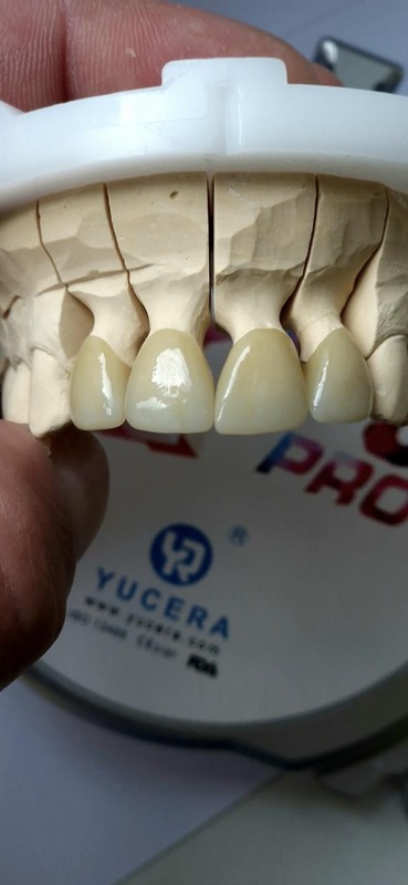 Yucera 4D PRO Esthetic  Multilayer Zirconia Disk Disc Block Open System(98mm) for Dental Lab