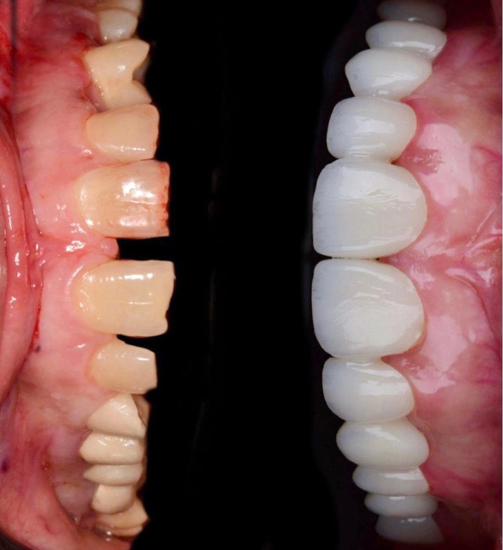 Yucera 4D Pro Zirconia Ceramic Dental Crown Dental Zirconia Disc Dental Zirconia Block Ceramic False Teeth Zirconia Block Dental