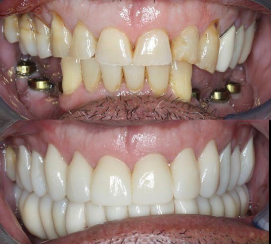 Yucera 4D Pro Zirconia Block for Professional Dental Labs, with Multiple Specifications Available Quality Guaranteed